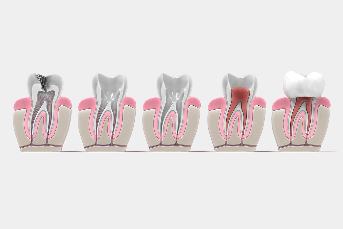 Endodoncia Acerca