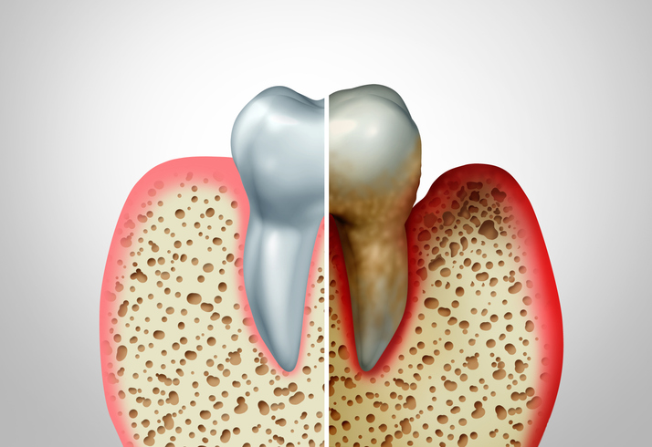 enfermedad periodontal avanzada