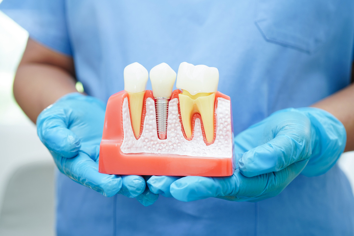 cómo recuperar dientes perdidos con implantes dentales