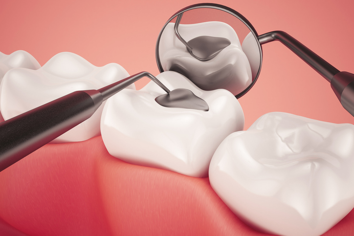 cuánto duran los empastes dentales