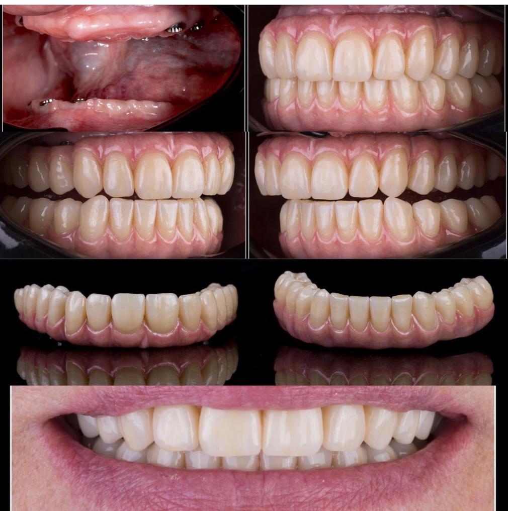Implantes Dentales Acerca